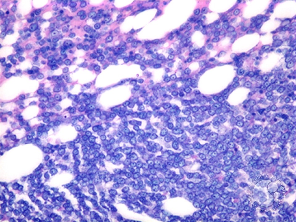 File:Giemsa stain of bone marrow biopsy showing sheets of plasma cells..jpg