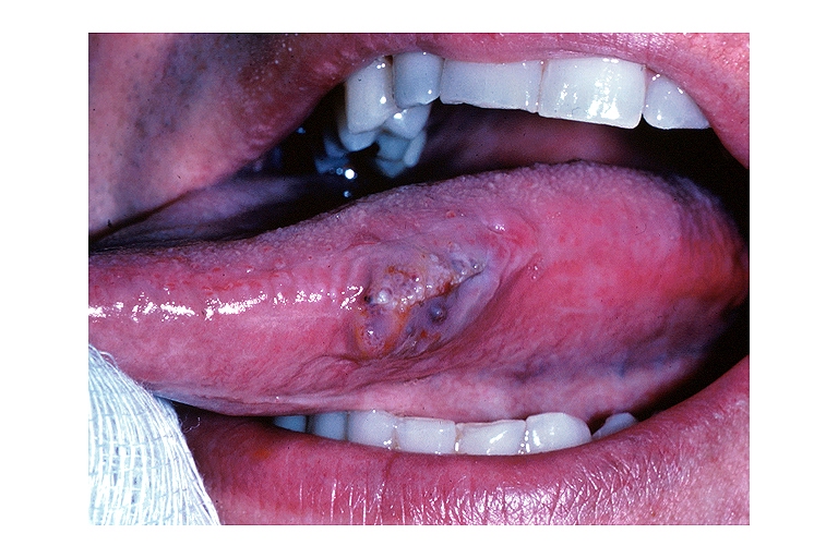 Lymphangioma oral 001.jpg