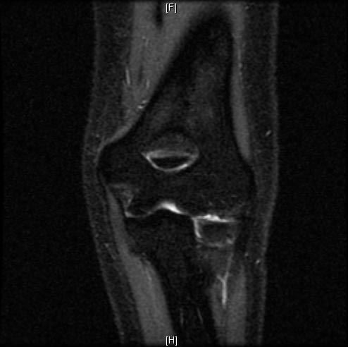 File:Normal-elbow-MRI-002.jpg