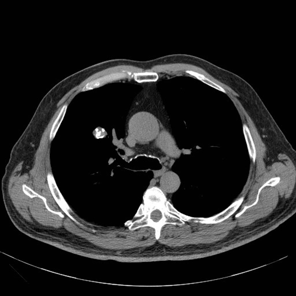 Axial CT scan (CT) shows a well circumcised lesion, with intralesional fat and calcification in the inferior right lobe.Case courtesy of Dr Yi-Jin Kuok, Radiopaedia.org, rID: 17407
