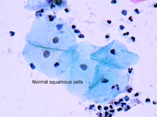 Squamous cells.jpg