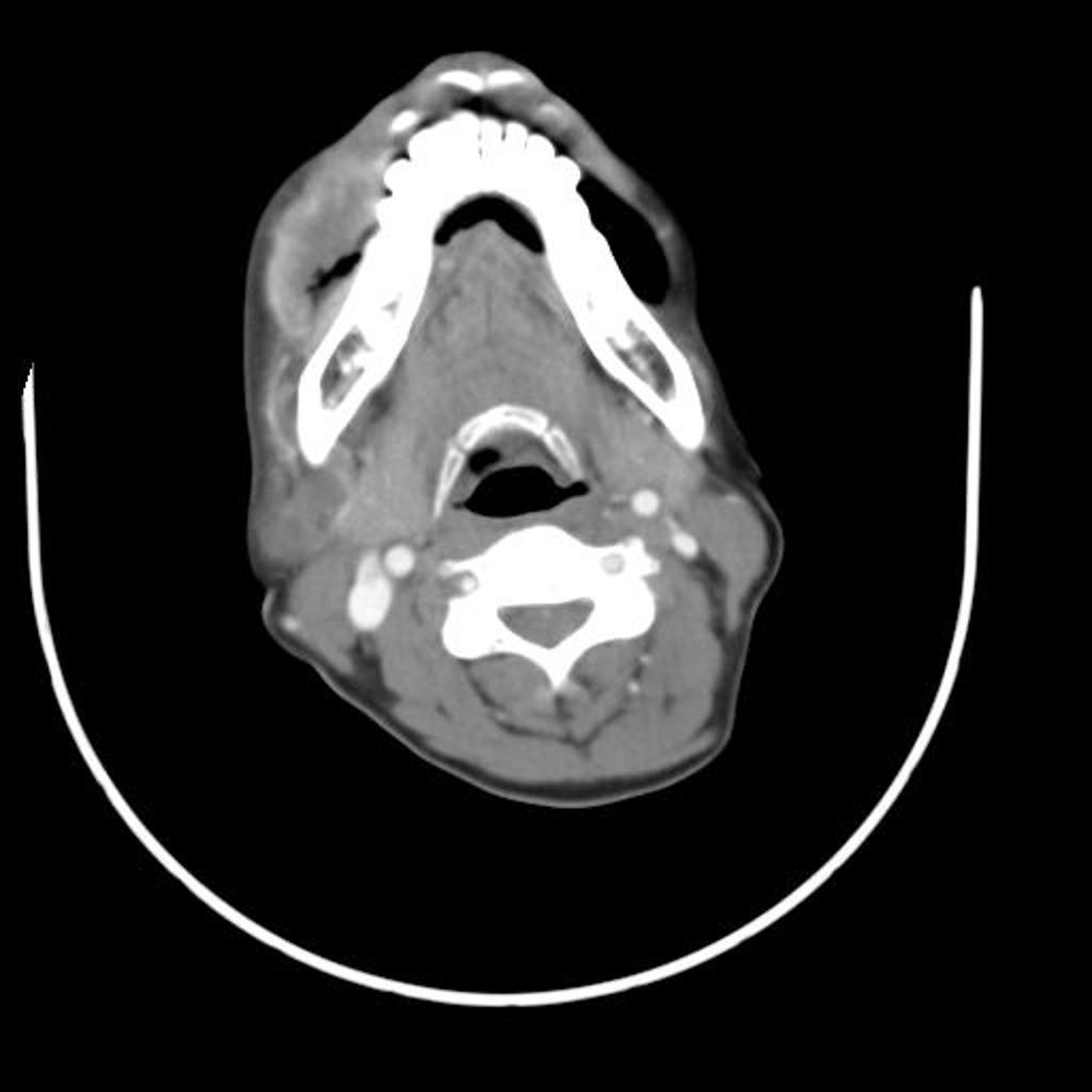 File:Buccal-squamous-cell-carcinoma.jpg