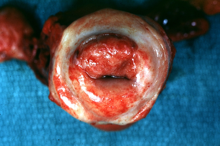 Uterus: Cervical Carcinoma: Gross, an excellent example of tumor (labeled as invasive) Image courtesy of Professor Peter Anderson DVM PhD and published with permission © PEIR, University of Alabama at Birmingham, Department of Pathology