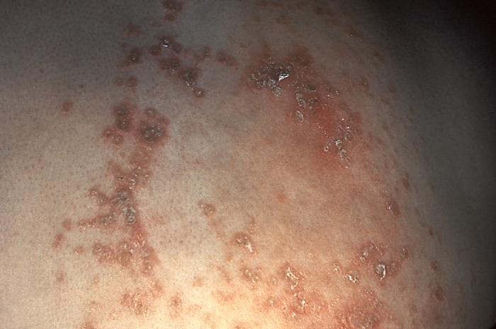Skin disorder was found to be herpes zoster. From Public Health Image Library (PHIL). [1]