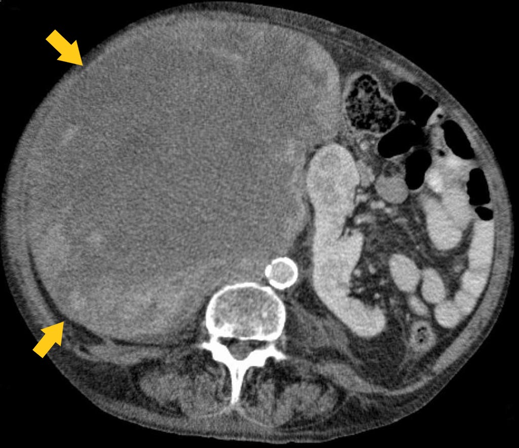 File:Lipsarcoma CT.jpg