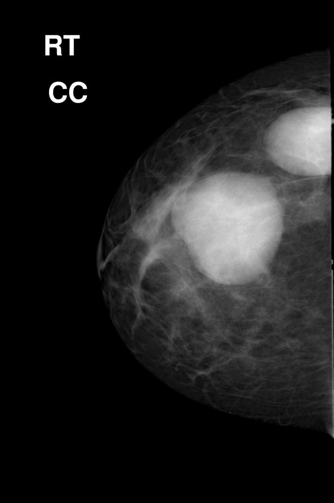 Mammography of phyllodes tumor Adapted from Radiopedia
