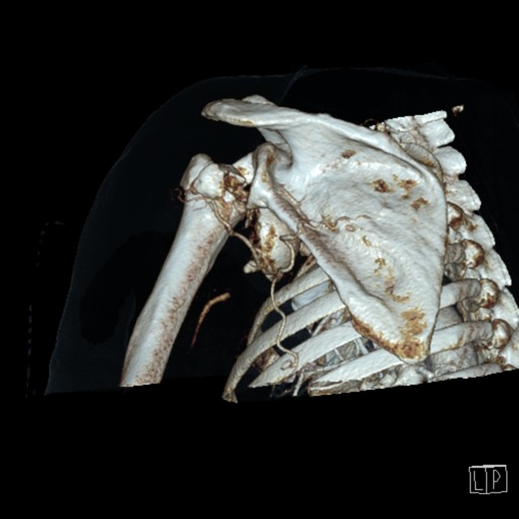 3D VRT- Complex, heavily comminuted proximal humerus fracture-dislocation. Off-ended surgical neck of humerus fracture with complete anterior displacement of the humeral head, which is dislocated from the glenoid anteriorly. Avulsion fracture of the greater tuberosity. Glenohumeral lipohemarthrosis. Surrounding fat stranding.