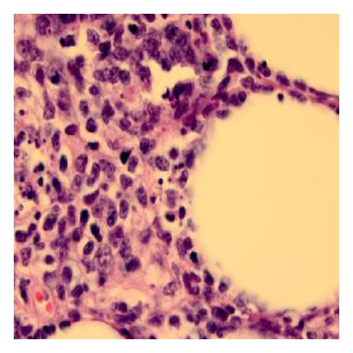 File:Subcutaneous panniculitis-like T-cell lymphoma biopsy 4.jpg