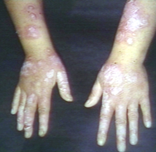 Skin: Lupus, systemic erythematosus; Discoid skin lesion in patient with SLE. Image courtesy of Professor Peter Anderson DVM PhD and published with permission © PEIR, University of Alabama at Birmingham, Department of Pathology.[4]