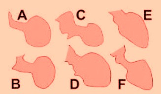 Different end-systolic left ventricular (LV) silhouettes. A, [19]; B, [20]; C, [21]; D, [22]; E, [23]; and F, [24]. There is wide heterogeneity among the different patterns, varying from a relatively small akinetic apical area in C to a wide global akinesia in D and E. [25]