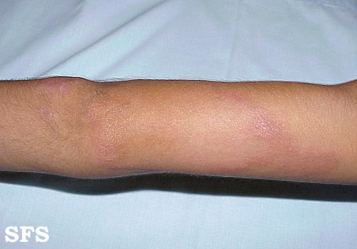 File:Tuberculoid leprosy16.jpg