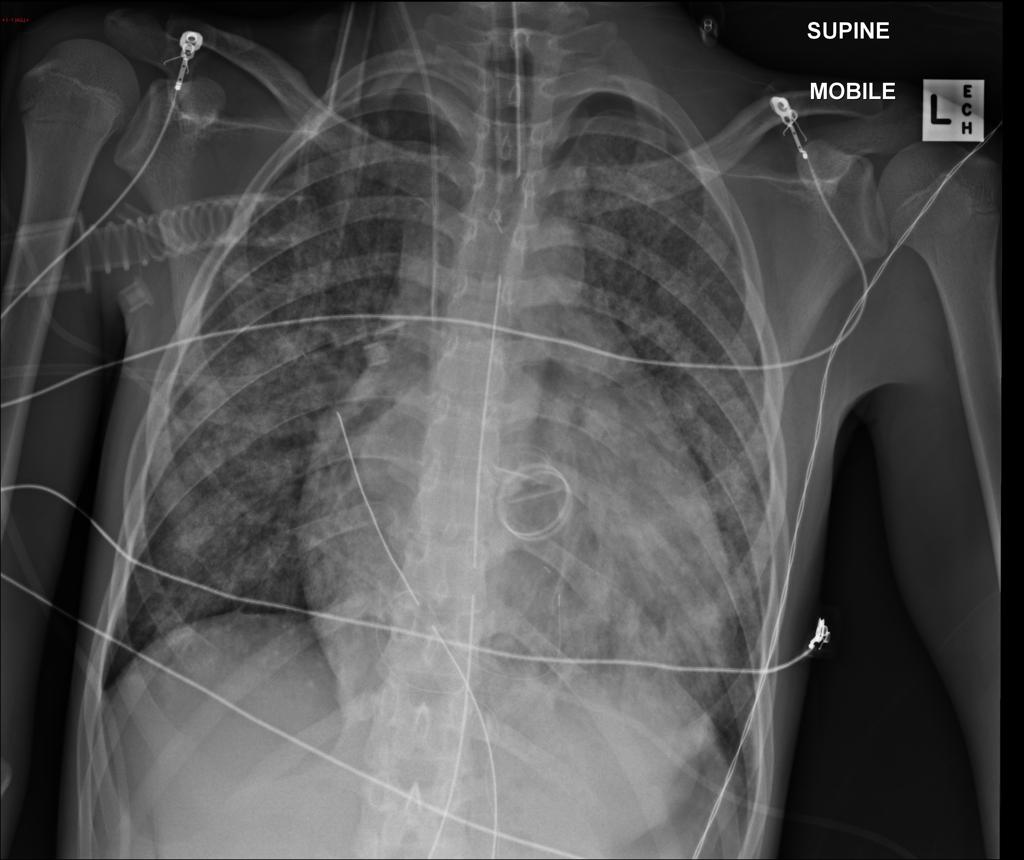 File:Acute Rheumatic Fever X-Ray 3.jpg