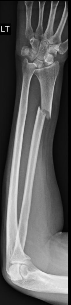 PA- Type 1 Galeazzi fracture