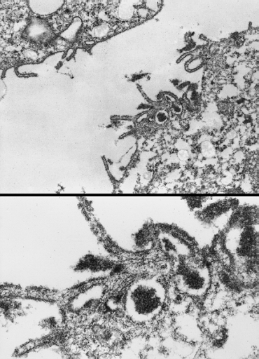HEART-GREAT VESSELS: MALIGNANT MESOTHELIOMA: PERICARDIUM Electron micrograph demonstrates elongated microvilli characteristic of mesothelial differentiation.