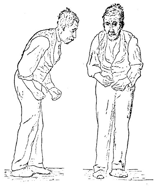 Sir William Richard Gowers Parkinson Disease sketch 1886.jpg