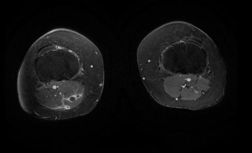 MRI: Superficial vein thrombosis