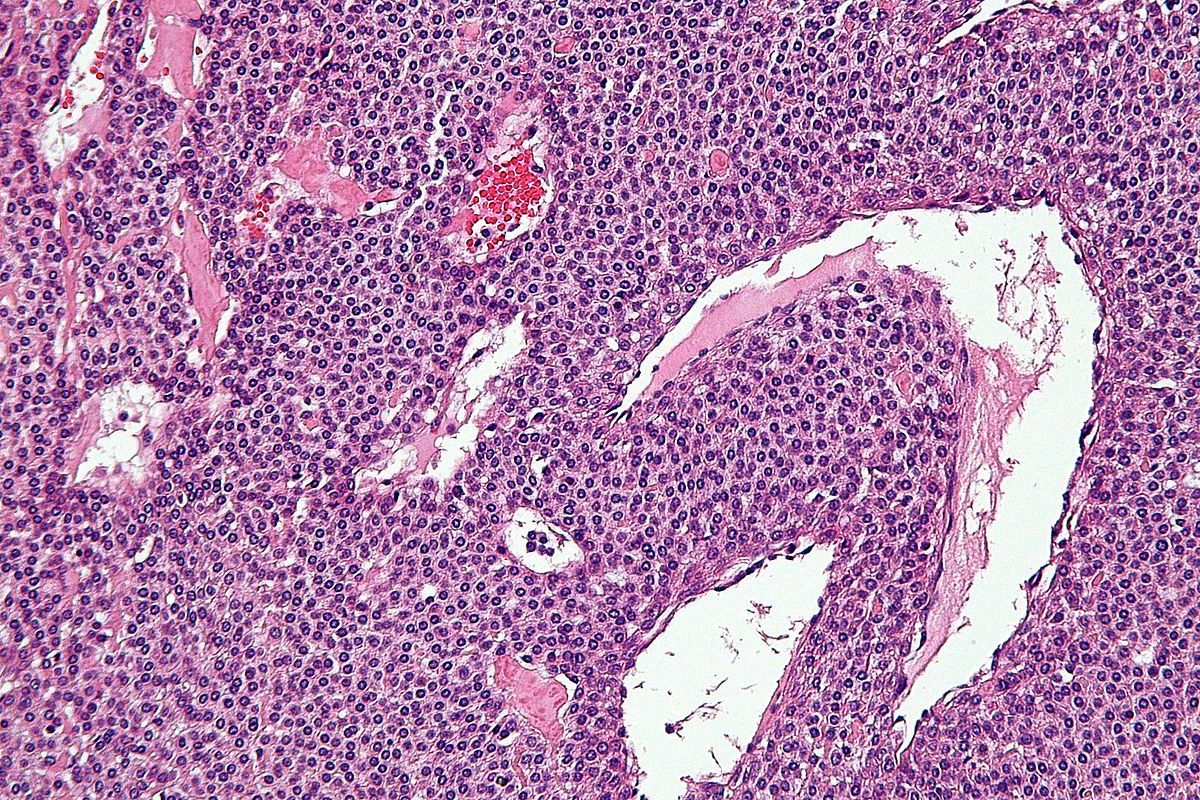 High magnification micrograph of a glomus tumor. H&E stain.[9]