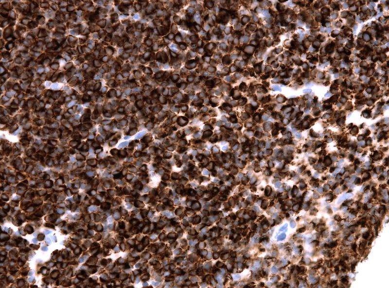 Immunohistochemical stain of a pineoblastoma demonstrating positivity to neurofilament.[8]
