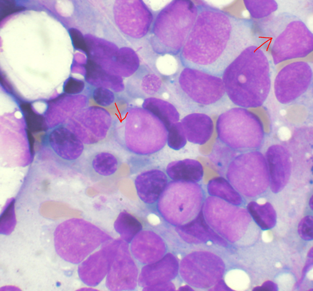 Bone marrow aspirate showing acute myeloid leukemia with Auer rods in several blasts
