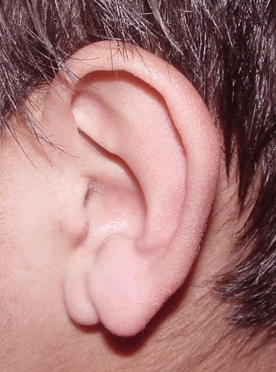 Bifid earlobe.[5]
