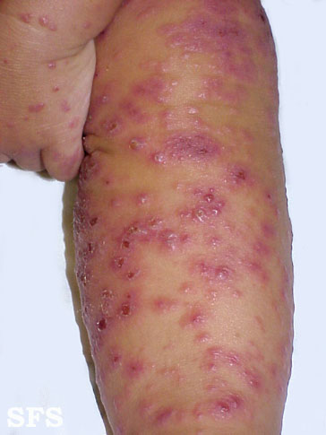 File:Eczema herpeticum04.jpg
