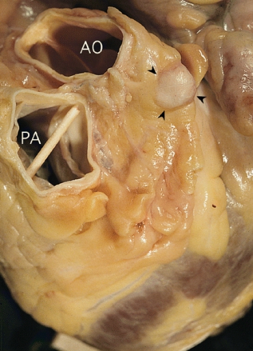 Granular cell tumor: Localized epicardial tumor (arrowheads) overlying the left main coronary artery close to its takeoff. Note aorta (AO) posterior to the pulmonary artery (PA).