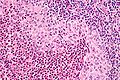 File:Langerhans cell histiocytosis - very high mag.jpg