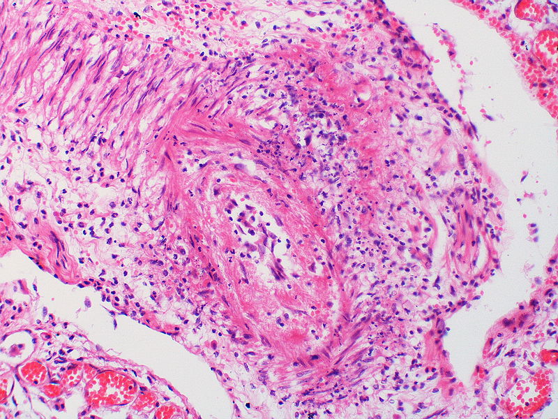 This artery exhibits vasculitis characterized by focal necrosis of the wall accompanied by inflammation.