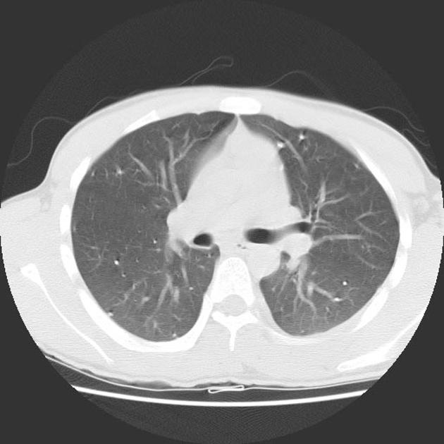 High attenuation nodules observed in both lungs.[2]