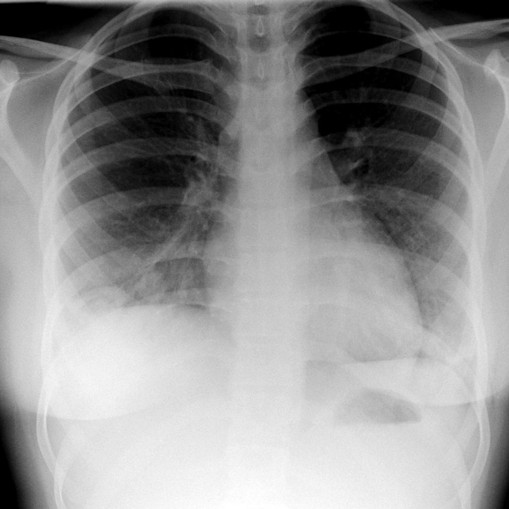 Granulomatosis with polyangiitis- X ray PA view showing air opacities Source:Radiopaedia.org[6]