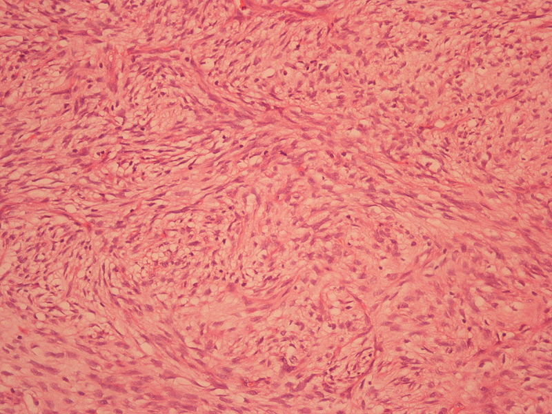 File:Well Differentiated Liposarcoma.jpg