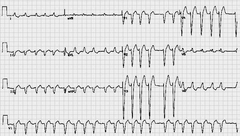 Atrial Fibrillation with old LBBB.jpg