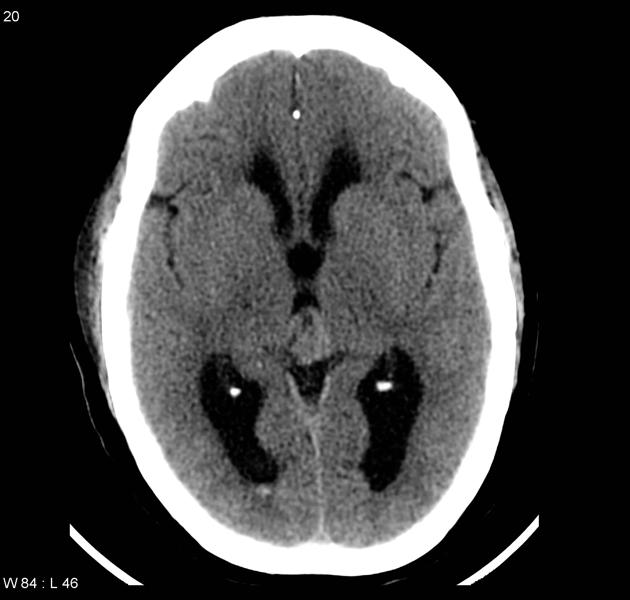 Single image following biopsy and third ventriculostomy demonstrates a pineal region soft tissue mass. A small amount of blood is seen in the occipital horn on the right. Ventricles remain dilated.[21]