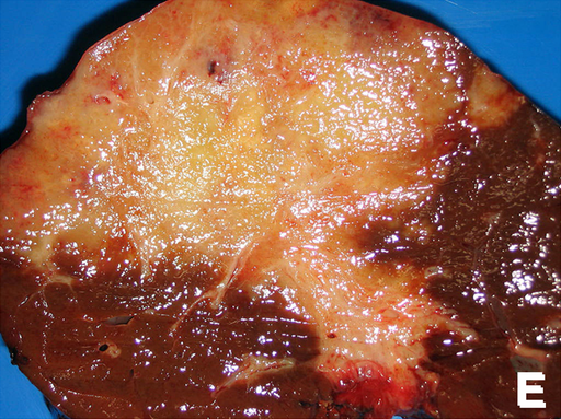 File:Cholangiocarcinoma.png