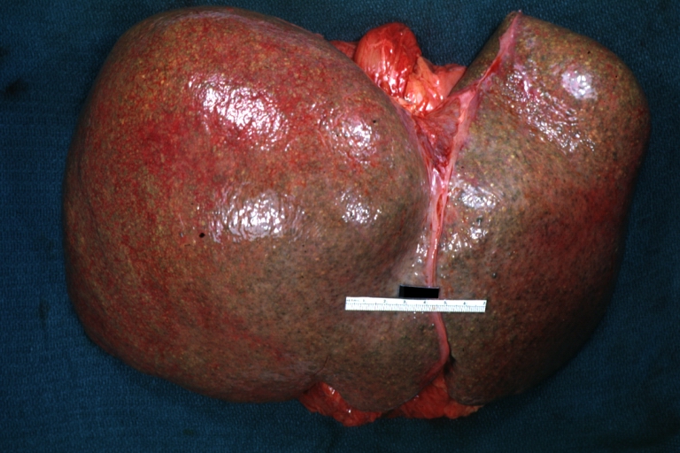 Micronodular cirrhosis: Gross, natural color view of whole liver through capsule with obvious cirrhosis (note to quite large liver)