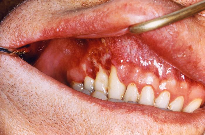 This image depicts an intraoral view, which reveals a lesion of the patient’s maxillary gingival mucosa that had been diagnosed as histoplasmosis, caused by the fungal pathogen, Histoplasma capsulatum. From Public Health Image Library (PHIL). [3]