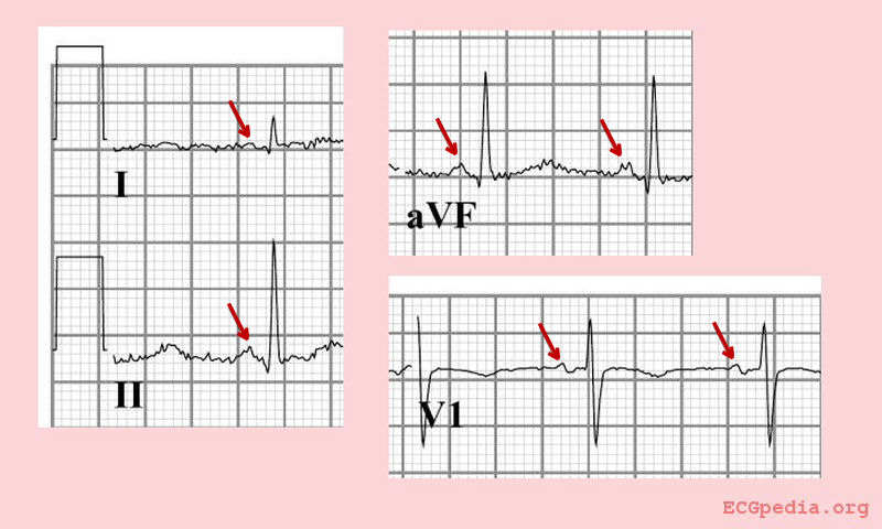 Normal sinus rhythm with a positive P-wave in I, II and AVF, and a biphasic P-wave in V1. The normal heart rhythm is sinus rhythm. That means that the rhythm has its origin in the sinus node, the heart's fastest physiological impulse generator.