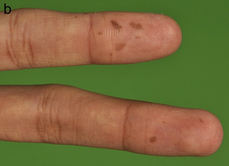 Hyperpigmentations on the finger tips.[2]