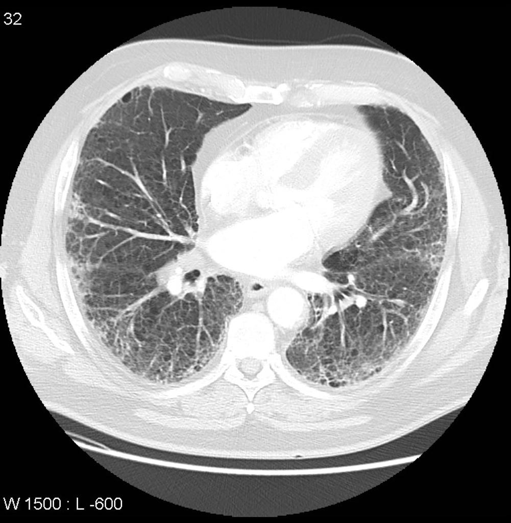 File:Rheumatoid-interstitial-lung-disease.jpg