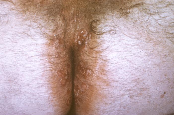 This image depicts the left axillary region of a female patient, who’d presented with what was described as condylomata lata lesions, due to what was diagnosed as a case of secondary syphilis. The secondary stage of syphilis is characterized by the manifestation of a skin rash and mucous membrane lesions. This stage typically starts with the development of a rash on one or more areas of the body. The rash usually does not cause itching. Rashes associated with secondary syphilis can appear as the chancre is healing or several weeks after the chancre has healed. The characteristic rash of secondary syphilis may appear as rough, red, or reddish brown spots both on the palms of the hands and the bottoms of the feet. However, rashes with a different appearance may occur on other parts of the body, sometimes resembling rashes caused by other diseases. Sometimes rashes associated with secondary syphilis are so faint that they are not noticed. In addition to rashes, symptoms of secondary syphilis may include fever, swollen lymph glands, sore throat, patchy hair loss, headaches, weight loss, muscle aches, and fatigue. The signs and symptoms of secondary syphilis will resolve with or without treatment, but without treatment, the infection will progress to the latent and possibly late stages of disease. Adapted from CDC