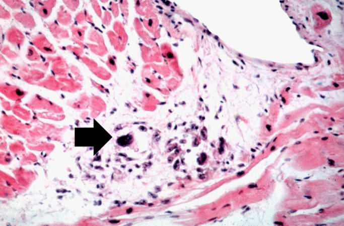 This high-power photomicrograph of myocardium shows the cellular detail of another Aschoff body. In this case there appears to be a multinucleated Aschoff giant cell (arrow).
