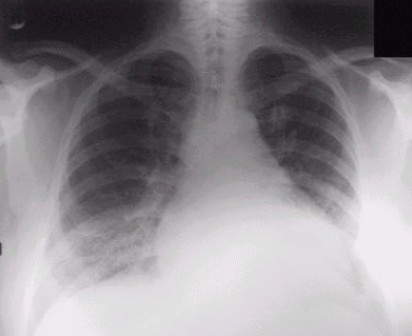 Chest x-ray shows left ventricular Hypertrophy due to aortic stenosis