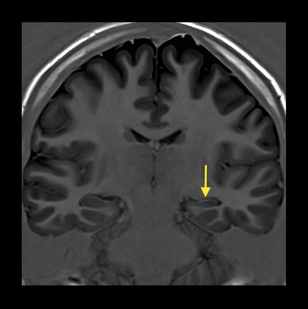 File:Mesial-temporal-sclerosis-8.jpeg
