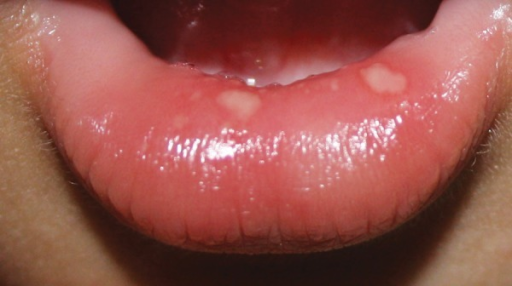 File:Oral ulcer 1.png