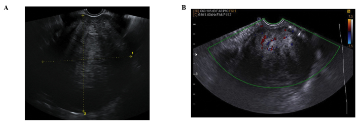 File:Ovarian fibroma ultrasound findings.jpg
