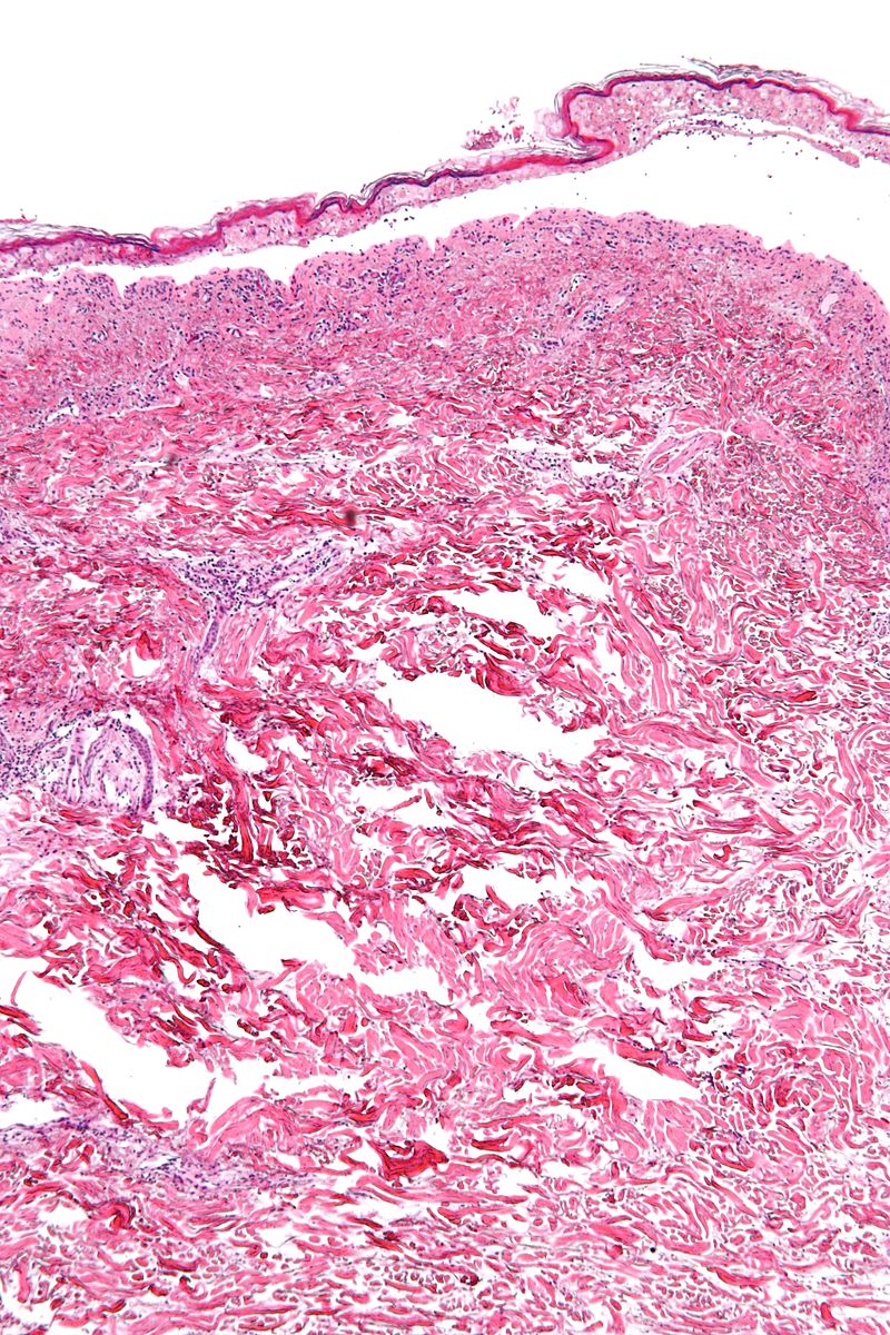 Confluent epidermal necrosis(low mag)[9]