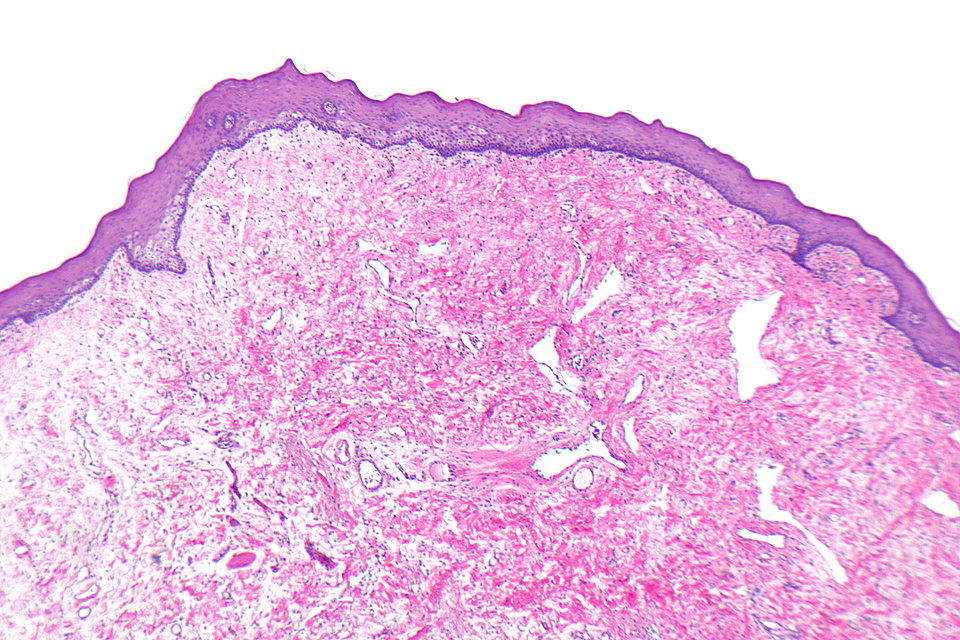 Histopathology specimen of a oral fibroma low magnification