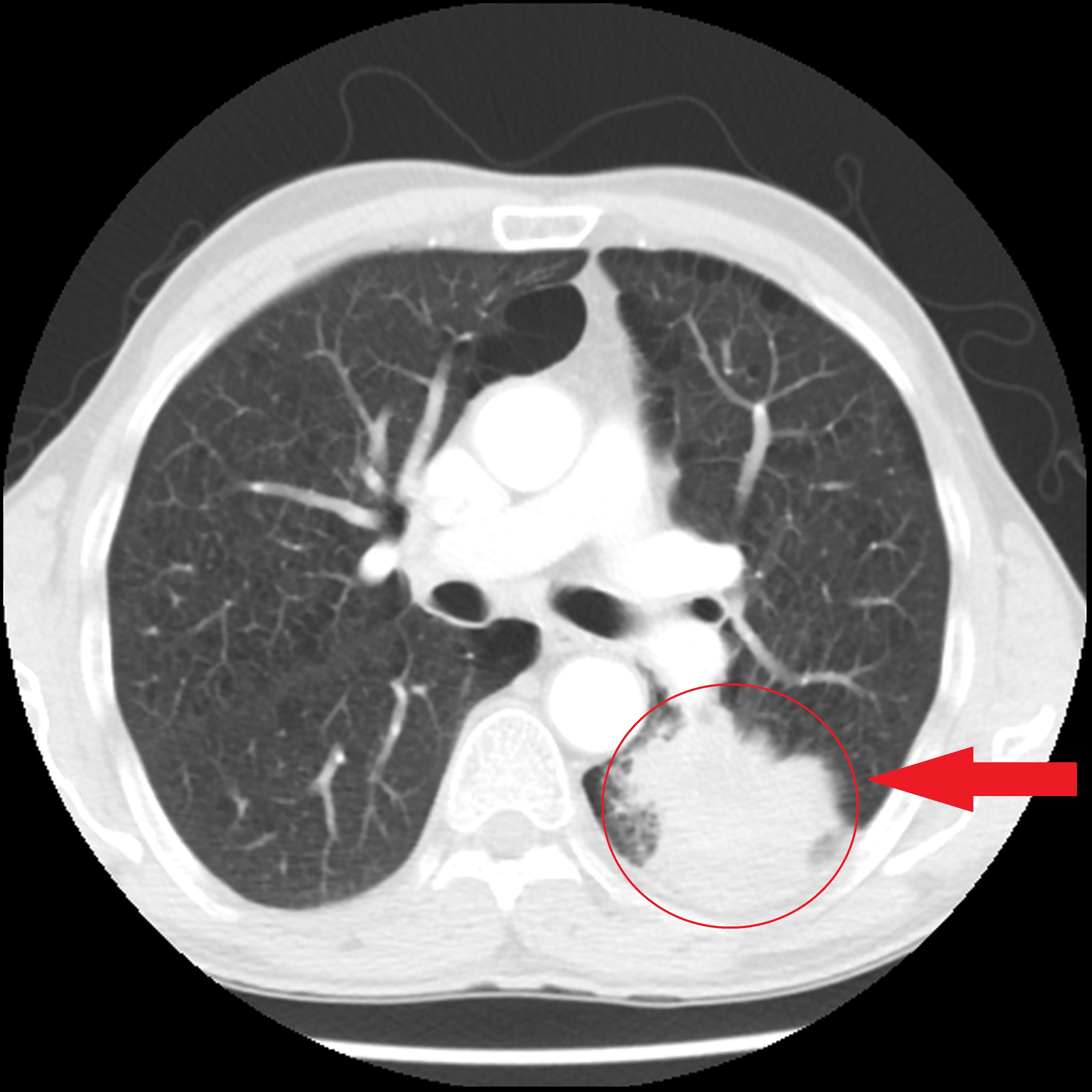 File:Adenocarcinoma-of-the-lung-6 (1).jpg
