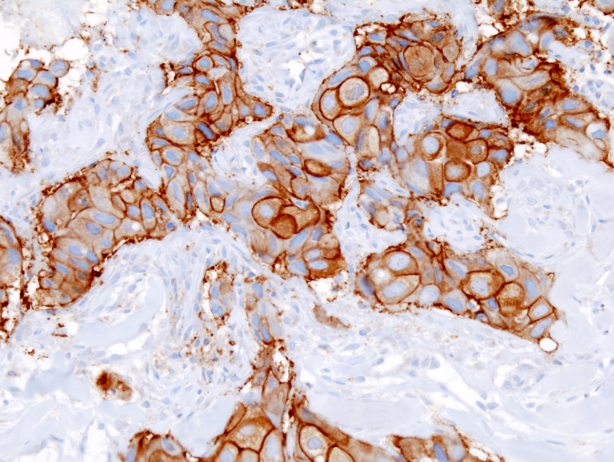 Histopathology of invasive ductal carcinoma of the breast representing a scirrhous growth. Core needle biopsy. HER-2/neu oncoprotein expression by Ventana immunostaining system.