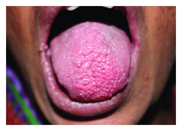 Cobblestone appearance of multiple confluent papules on the tongue.